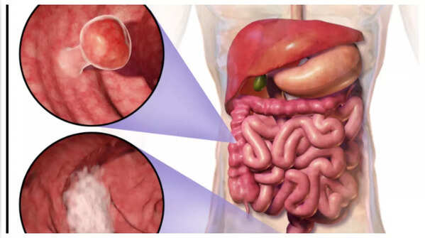 Illustration showing blood in stool